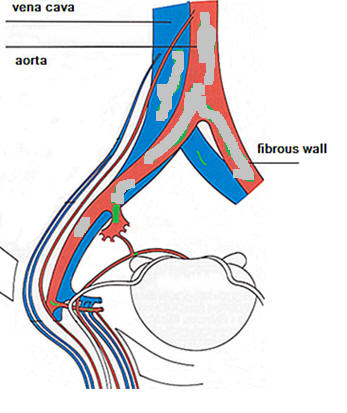 arteriosclerosis