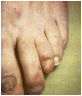 gangrene pied avec testoterone