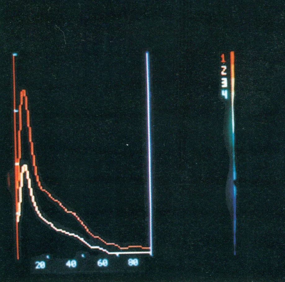 néphrogramme isotopique anormal.jpg